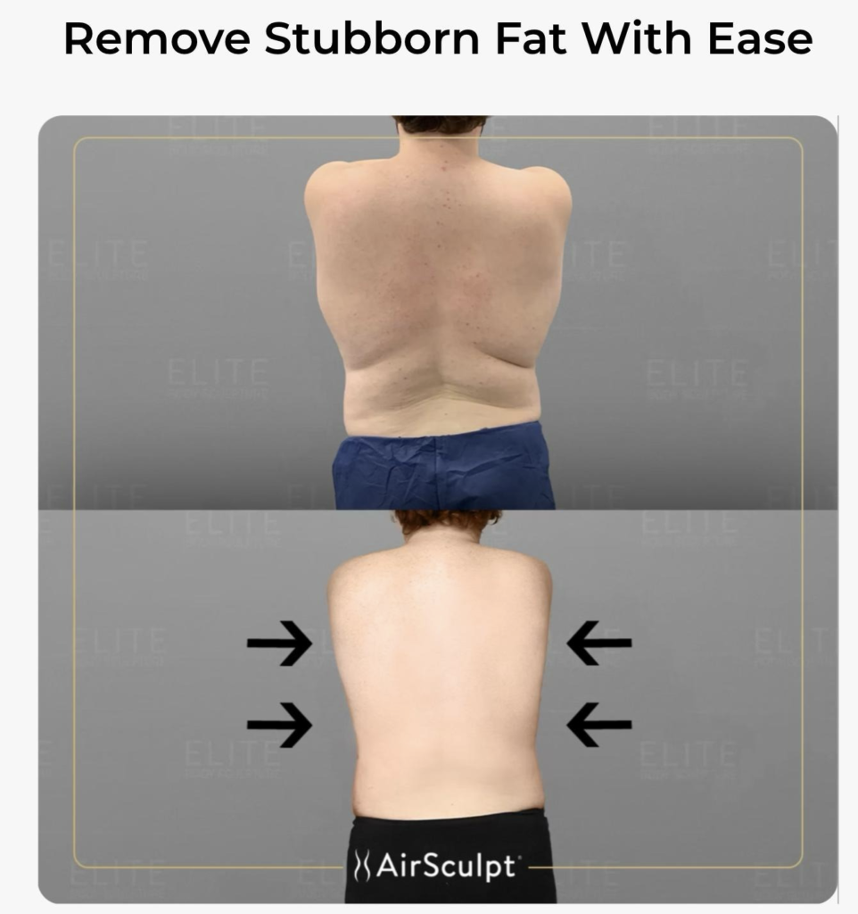 AirSculpt® Brazilian Butt Lift Details & Before and Afters